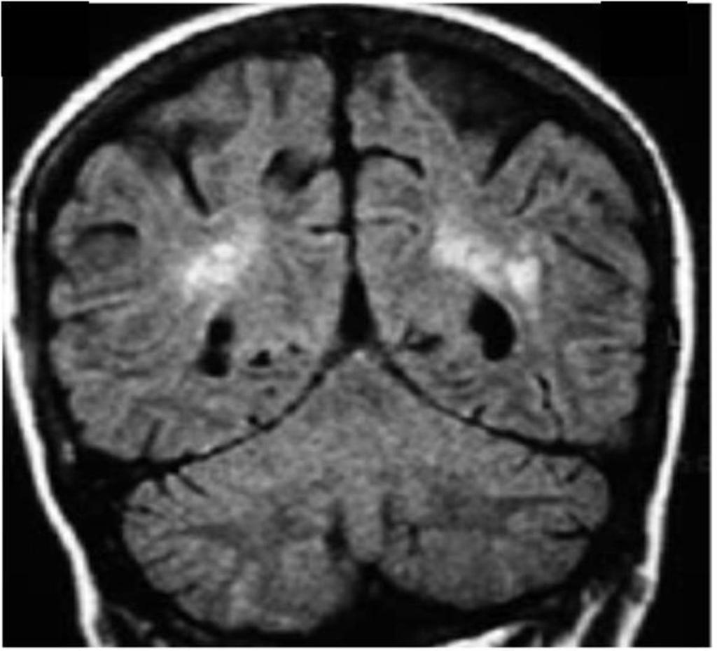 Score 2 was attributed to more severe/diffuse leukoencephalopathy with lesions >3 cm.
