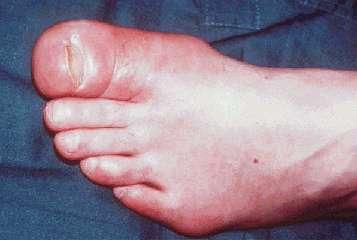 Differential diagnosis 1. Gout 2.