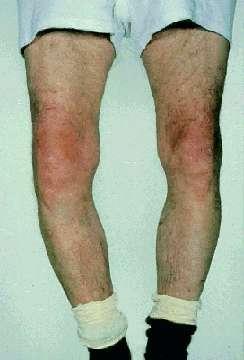 Longstanding arthritis (Chronic) leads to deformity Varus