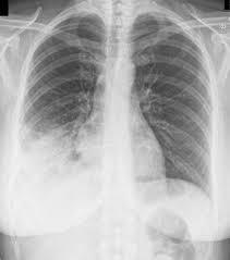 of Interest: None A 62 year-old female presents to the ED with fever, cough, dyspnea.