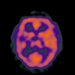 PET vs. CT Scans! CT images brain structure.! PET images brain function.