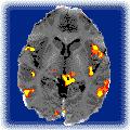 Functional MRI (fmri) (1990s)! Images brain hemodynamics!