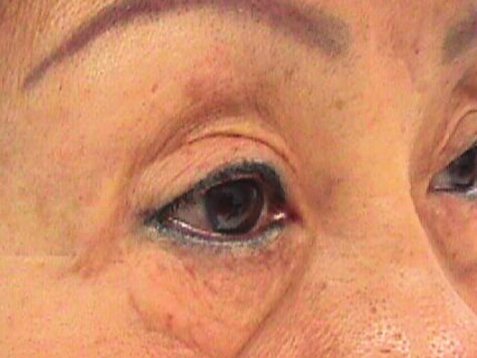 Volume 119, Number 1 Glide Zone in Upper Blepharoplasty Fig. 4. Photograph of scarred upper lid/stiffened eyelid skin with underlying cicatrix in the pretarsal and preseptal areas.