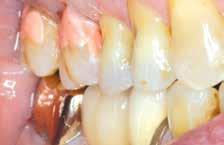Root surface protection describes the application of a thin film of glass ionomer to exposed root surfaces for those patients with an increased risk of caries or erosion.