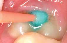 Posterior teeth are at increased risk of developing caries during eruption due to the increased levels of plaque retention, immaturely formed enamel and the length of time taken to achieve full