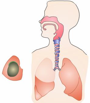 After the operation, one or more chest tubes may be placed in your chest. These tubes help drain the excess fluid and air to the outside and help heal the remaining lung.