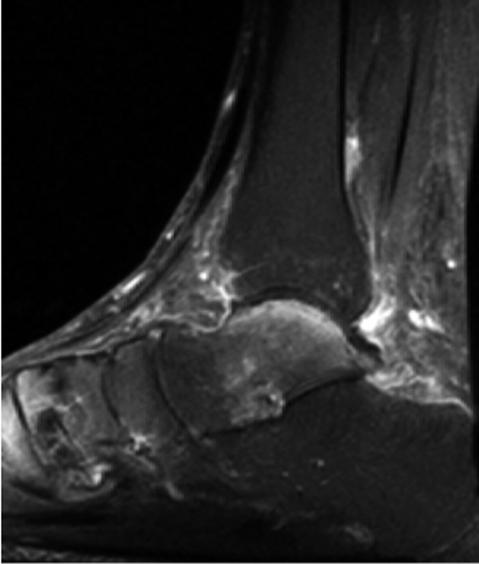 Imaging findings include a strong edema in the trabecular bone of the talus and high signal intensity within the soft tissues around the ankle.