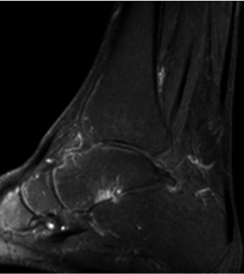 of the ankle joint (Fig. 4a). Fat-suppressed T1 images show a minor slight enhancement within the same region (Fig. 4b).