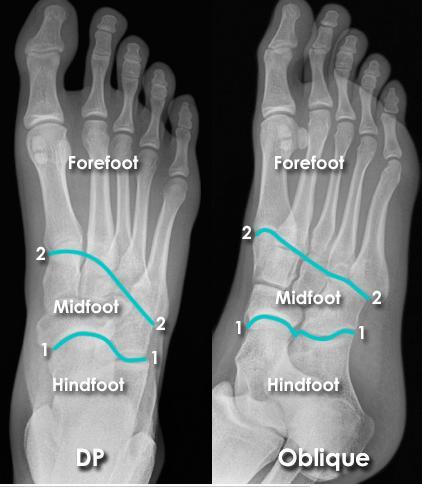 Standard views Foot X-ray anatomy - DP and Oblique views Dorsal-Plantar (DP) and Oblique - are standard projections of the forefoot.