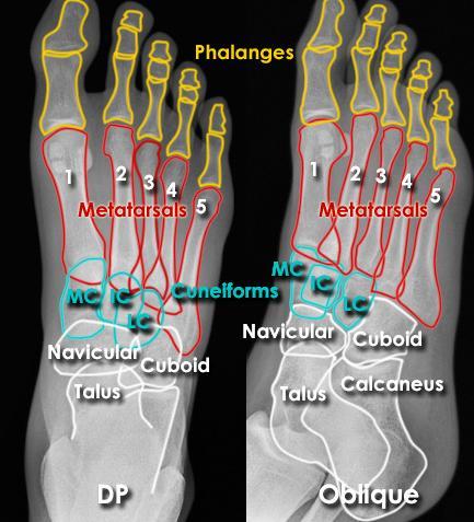 foot X-ray anatomy - DP and Oblique views Metatarsals and phalanges of the toes are numbered 1 to 5