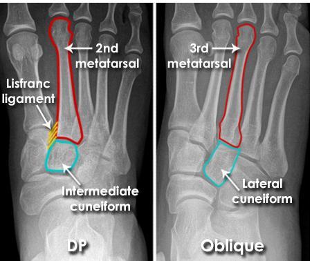 Lisfranc injury The 'Lisfranc' ligament stabilises the mid-forefoot junction.