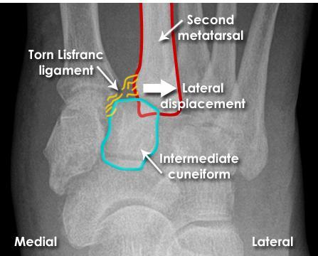Lisfranc injury - DP Second metatarsal displaced from the intermediate cuneiform No fracture is visible but this is a severe injury which is debilitating if untreated NOTE: Lisfranc
