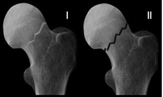 Fractures of the femoral neck do not always cause loss of Shenton's line I -