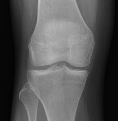 Knee - Normal AP radiologymasterclass.co.