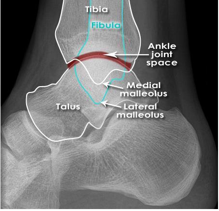 Ankle anatomy - Normal Lateral Carefully following the bone contour of the