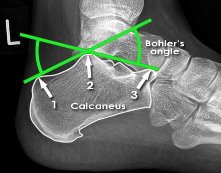 Bohler's angle radiologymasterclass.co.uk Severe injury may result in flattening of the calcaneus. This results in a reduction of 'Bohler's angle'.