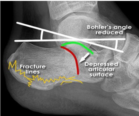 The first line is drawn from (1) - the upper edge of the calcaneal body posteriorly to (2) - the upper edge of the posterior articular facet of the