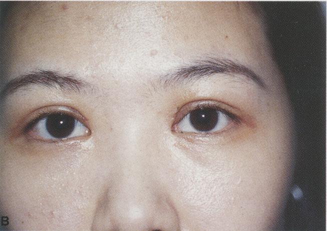 Figure 3~(A) Preoperative view of a young girl with prominent medial epicanthal folds. (B) Postoperative view 2 weeks alter the double eyelid surgery.