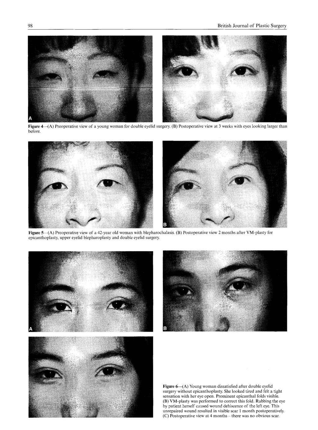 98 British Journal o f Plastic Surgery Figure 4--(A) Preoperative view of a young