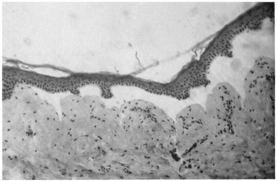 . 'i_s p 4 FG. 5. Microphotogrph of n rtificilly spred bullous pemphigoid (chronic pemphigus vulgris) blister. Note the lysis in the derml-epiderml junction. To the left the dvnced edge is rounded.