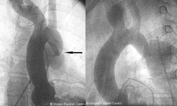 Figure 2 Angiogram as figure 1. As the coarctation segment could not be crossed retrogradely with various combinations of catheters and guidewires, the femoral vein was cannulated.