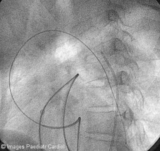 patient underwent coronary artery bypass grafting for a severe stenosis of the left anterior descending
