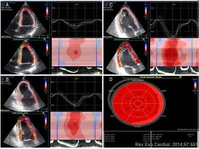 A.M. BEBEȘELEA et al.: Multimodality Imaging in the Assesment of Ischaemic Heart Disease 17 object relative to its original dimension. Expressed as a percentage (elongation +%, shortening -%).
