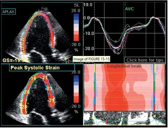 The main advantage of myocardial deformation imaging is its ability to detect early changes in ventricular function before decreasing LVEF and other conventional parameters [11].