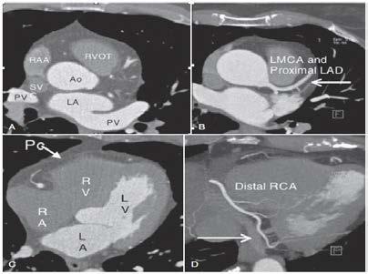 The current CMR protocols for ischaemic heart disease integrate morphological, cinematic, contrast, late contrast, stress tests, allowing visualization of edema, myocardial perfusion in rest and
