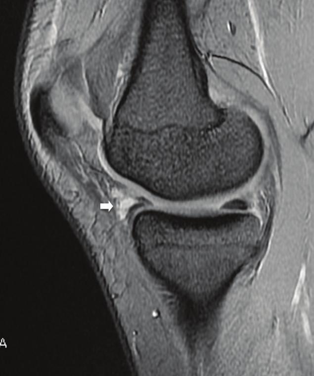 the anterior horn of the medial meniscus.