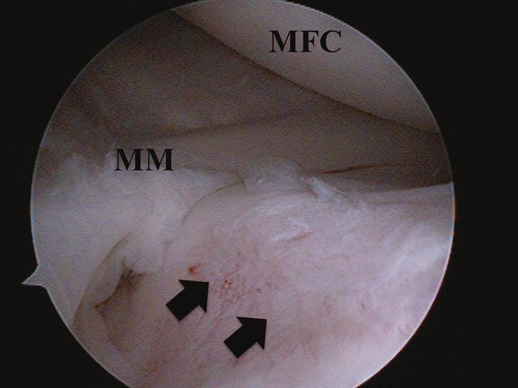 White arrows indicate the lesion.