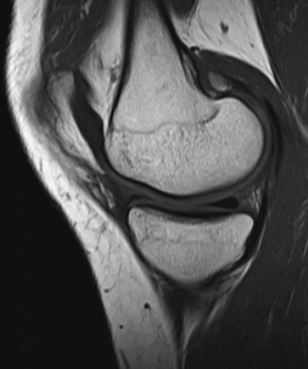 Case Reports in Orthopedics 3 Figure 3: No abnormal signals adjacent to the anterior horn of the medial meniscus were noted on magnetic resonance images at 12 months postoperatively.