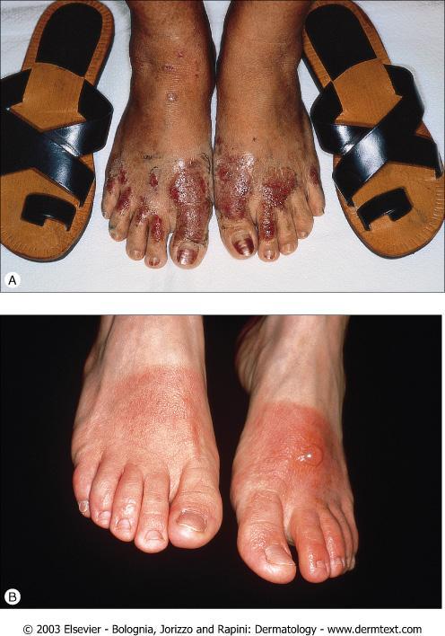 Allergic contact dermatitis to leather shoes.