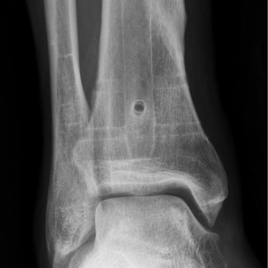C-D, AP and Lateral radiographs of the distal tibia show the distal portion