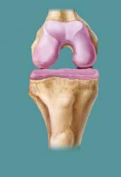 Joint Replacement Will focus on Knee and Hip OA amd joint