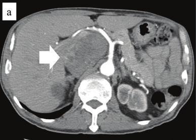 2 Cse Reports in Medicine Figure 1: Enhnced computed tomogrphy (CT) of the domen reveled slightly enhnced heterogeneous tumor, 18 mm in dimeter, etween the Spiegel loe of the liver nd the IVC in