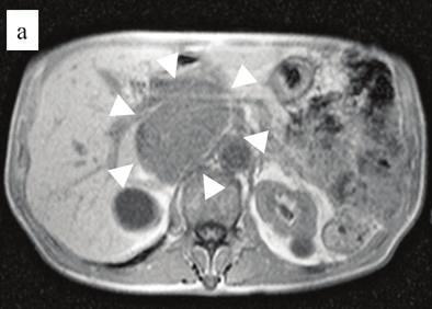 Mgnetic resonnce imging (MRI) of this tumor reveled contrsting low intensity on the T1-weighted imge ( rrow hed) nd high intensity on the T2-weighted imge ( rrow hed). his vitl signs were stle.