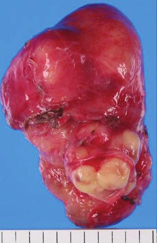 Cse Reports in Medicine 3 Figure 3: The resected specimen ws solid with smooth surfce.