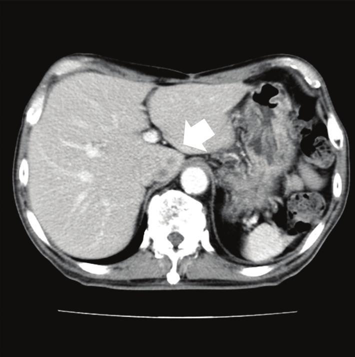 4 Cse Reports in Medicine Figure 5: Enhnced computed tomogrphy (CT) of the domen. The tumor ws detected in the Spiegel of the liver on enhnced CT of the domen (rrow).
