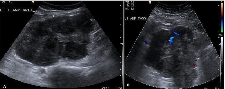 Fig. 1: A) Greyscale Ultrasound image shows a large heterogeneous hypoechoic solid left adnexal mass. B) Color Doppler Ultrasound shows internal vascularity within the mass.