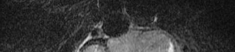 A 29-year-old female s T2-weighted images of spine MRI