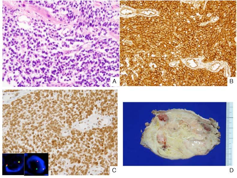 cells with eosinophilic cytoplasm (A), with strong CD99 (B) and