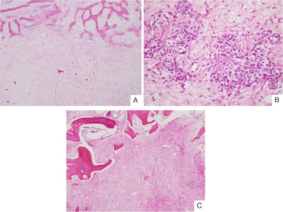 3A, B). The second case contained loose or edematous fibrotic scar tissue replacing the tumor that was heavily endowed with fine and delicate vessels (Fig. 4A).