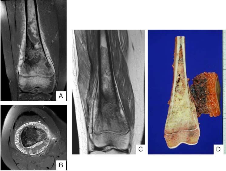The sclerotic sheet-like osteoid matrix with vascular channels is observed after chemotherapy (B, C), and viable tumor cells are remained among abundant eosinophilic matrix (D). Fig. (7).