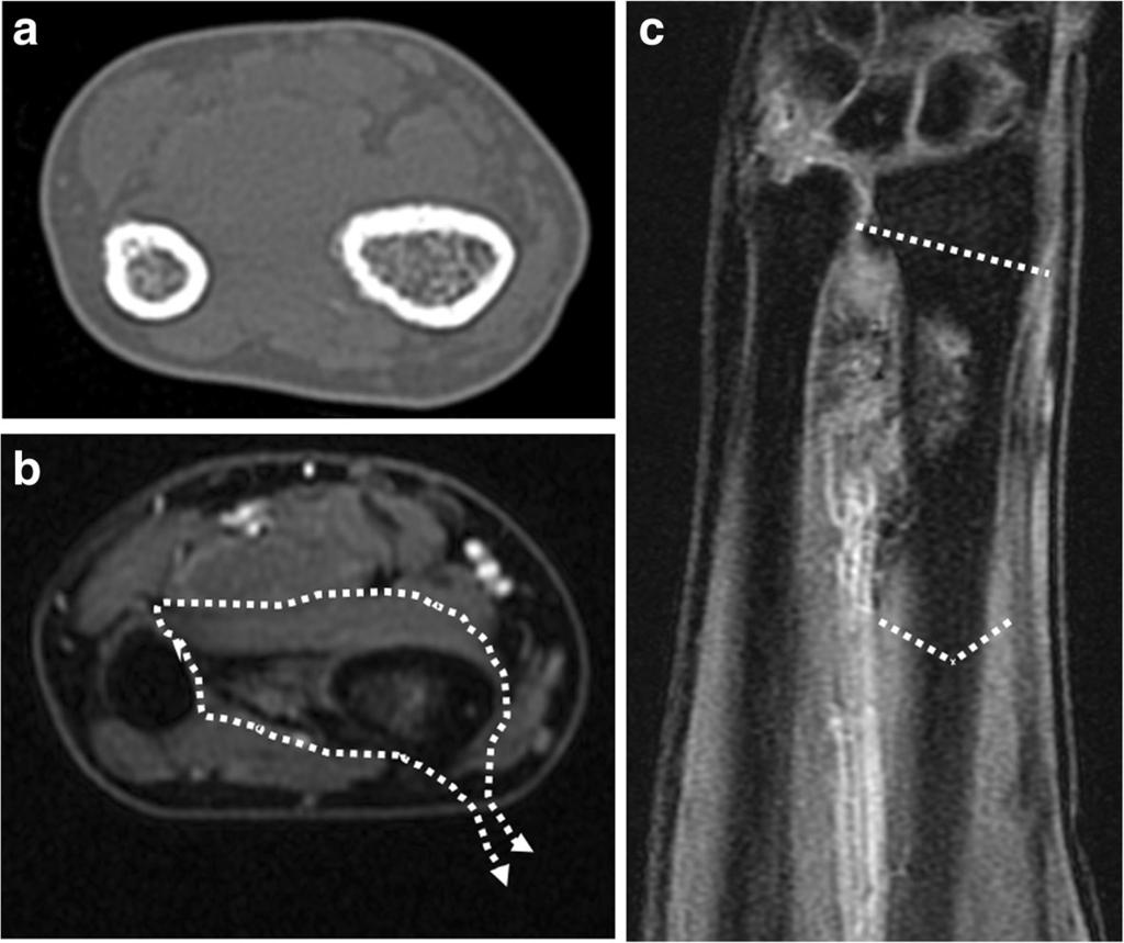 Higuchi et al. BMC Surgery (2018) 18:12 Page 3 of 7 Fig. 2 After neoadjuvant chemotherapy. a CT axial image (bone condition). Periosteal reaction was detected prior to chemotherapy.