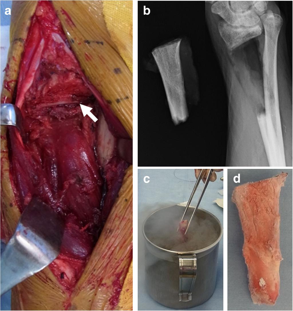 Higuchi et al. BMC Surgery (2018) 18:12 Page 4 of 7 Fig. 3 Intraoperative photos (a) The dorsal approach at the flexible side of the radiocarpal joint.