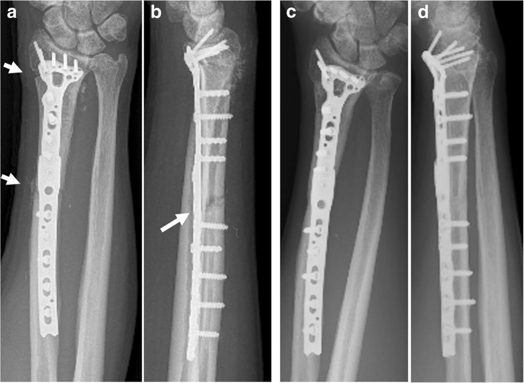 that mentions wrist joint preserving surgery in osteosarcoma [17]. In this study, the affected limb was reconstructed with a free fibular shaft after en bloc intercalary resection of the tumor bone.