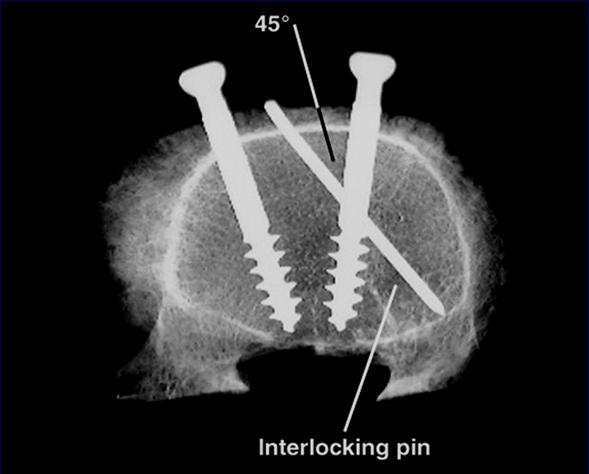 compared to standard screws No clinical