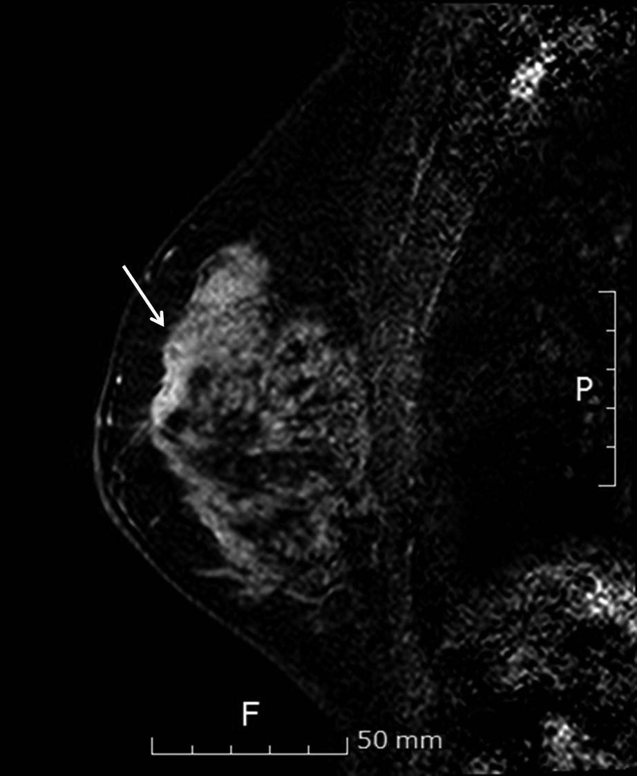 460 Gi Won Shin, et al. Figure 1. Initial mammograms.