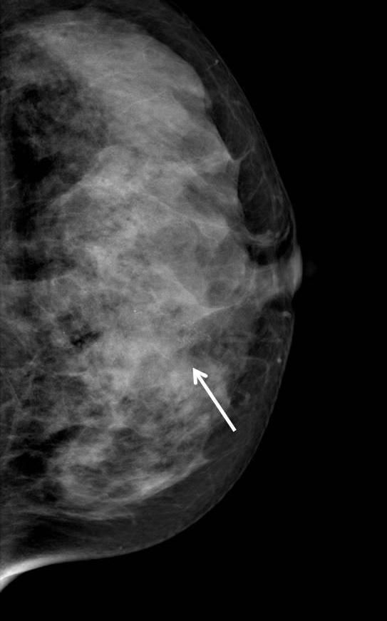 microcalcifications in the left upper inner breast (arrows).